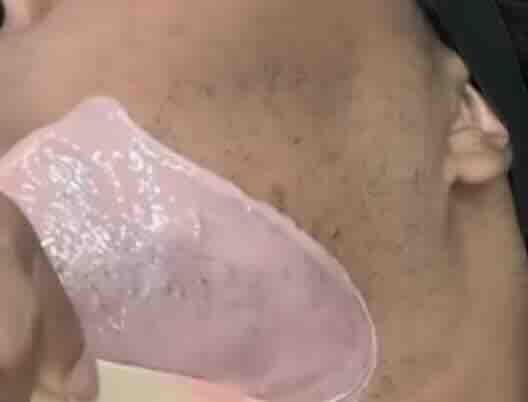 Kıllanma (Hirsutizm) Nedir? Neden Olur? Nasıl Tedavi Edilir? Ankara Kadın Doğum Uzmanı Rehberi