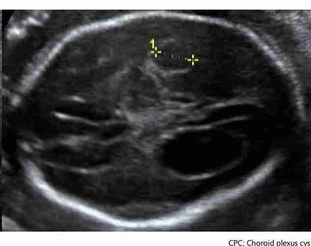 Koroid Pleksus Kistleri
