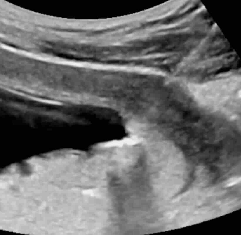 Koryon Nedir? Koryon Villus Nedir? Koryonisite Nedir?