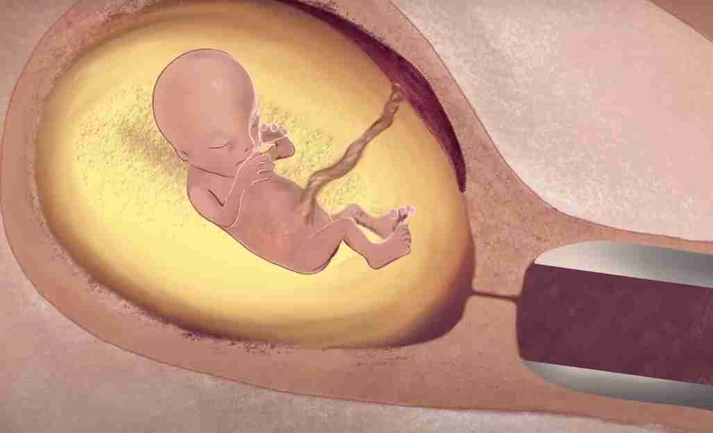 Kürtaj Başarısızlığı: Belirtileri ve Nedenleri