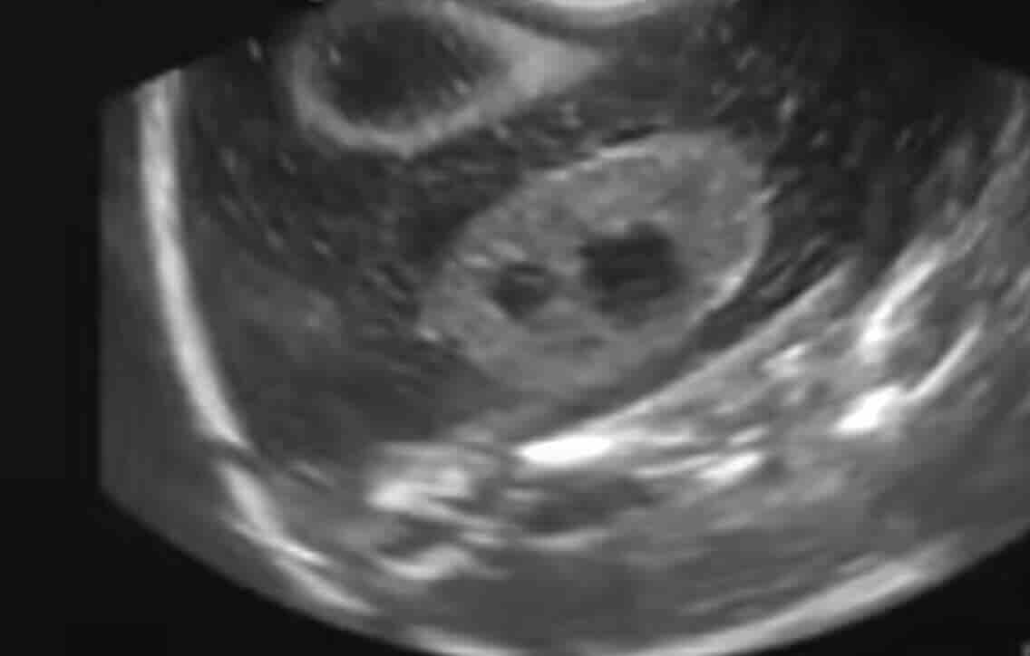 Kürtaj Ücretleri Ankara 2026