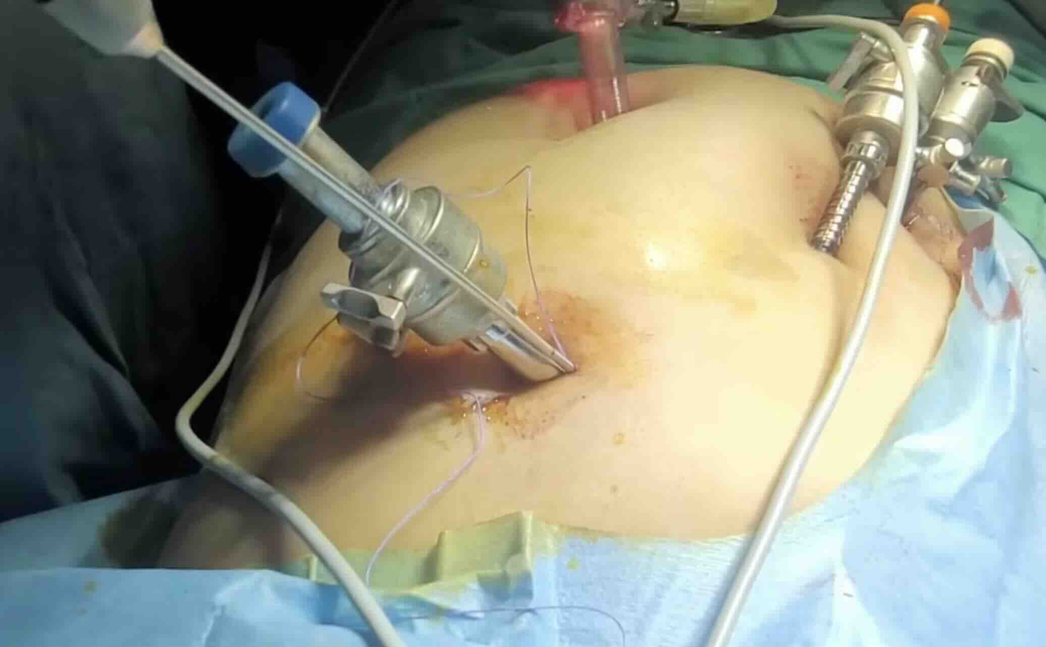 Laparoskopi (kapalı ameliyat)