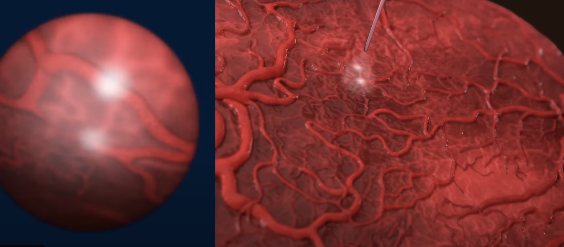 Monokoryonik Gebelikler ve TTTS (İkizden İkize Transfüzyon Sendromu)