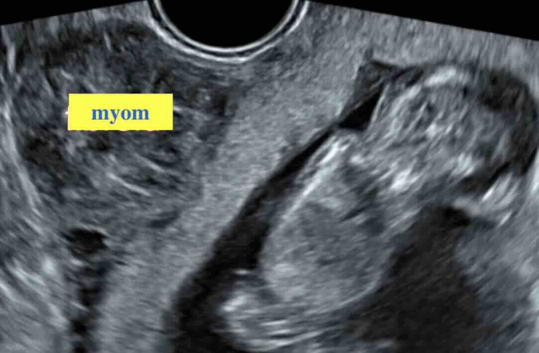 Myomlar Gebeliği Engeller mi?