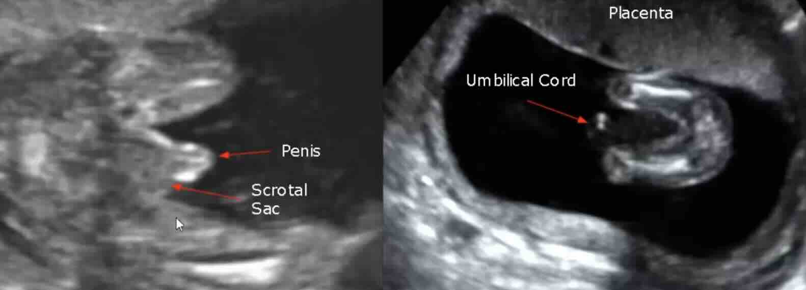 Nub Teorisi Nedir? Ultrasonla Erken Cinsiyet Tahmini