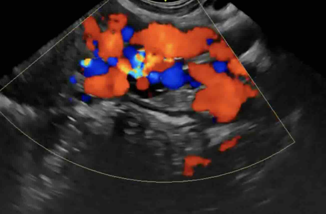 Pelvik Konjesyon Sendromu  Ankara Kadın Doğum  Rehberi