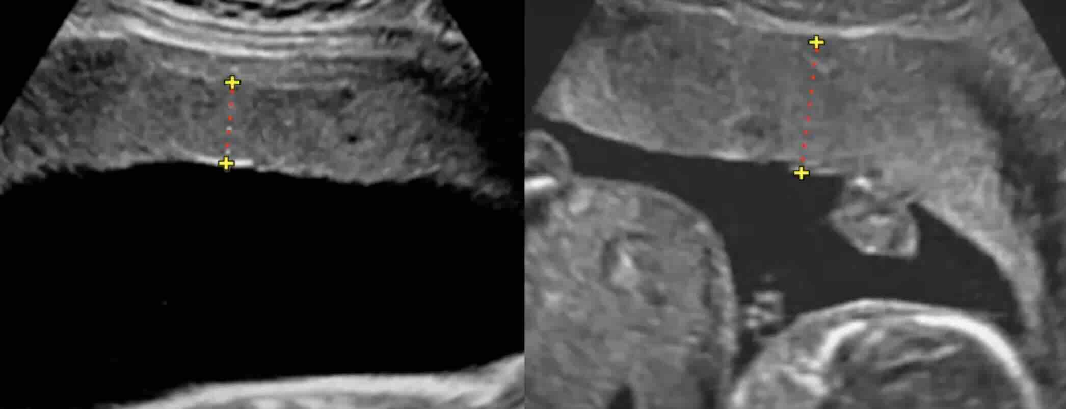 Plasenta Büyümesi (Plasentomegali) ve Gebelik Üzerindeki Etkileri