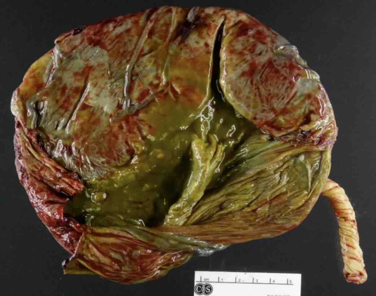 Plasenta Patoloji Sonuçları ve Anlamları: Bebeğin Aynası Olan Plasentayı Anlamak