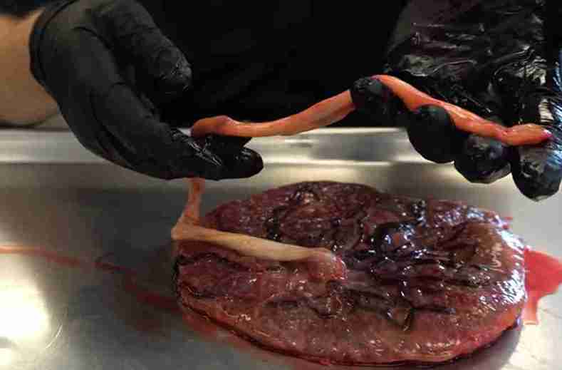 Plasenta ve Kordon Çeşitleri ve Gebelik Üzerine Etkileri