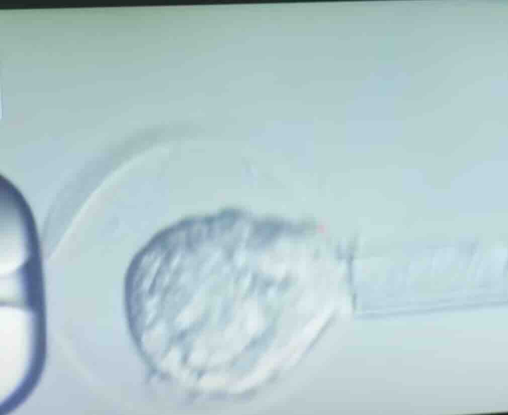 Preimplantasyon Genetik Tanı (PGT) ile Sağlıklı Bir Geleceğe Adım Atın