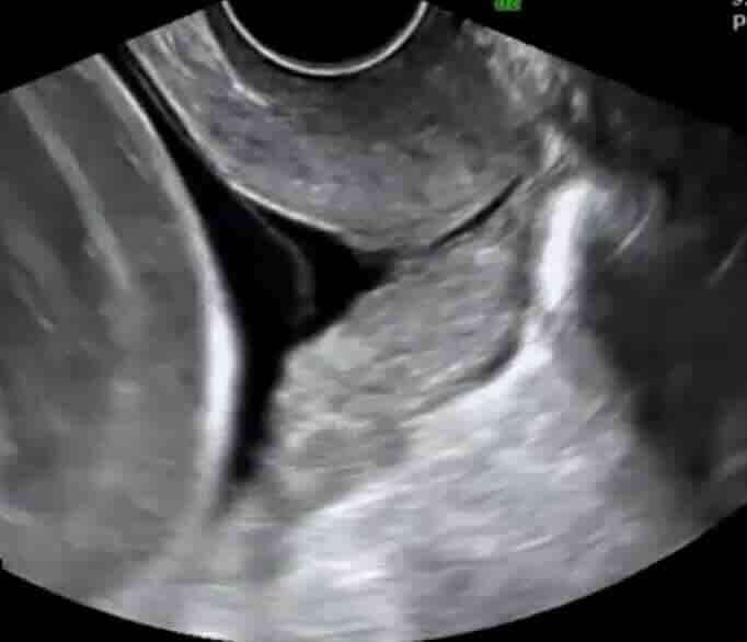 Rahim Ağzı Yetmezliği ve Serklaj FiyATLARI Ankara 2026