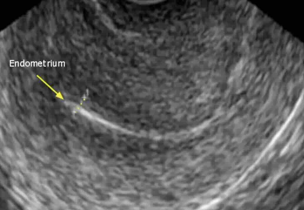 Rahim Duvarı İnceliği (Endometrium İnceliği) Nedir? Gebeliği Engeller mi?
