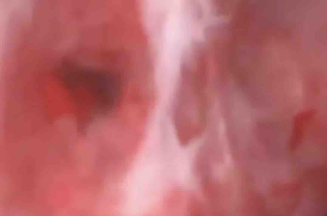 Rahimde Yapışıklık Nedir?