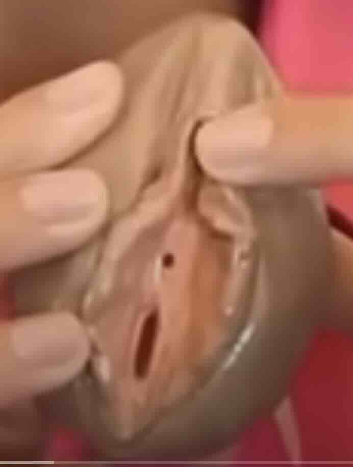 Revizyon Labioplasti: Memnun Olunmayan Ameliyatın Ardından Gelen İkinci Şans