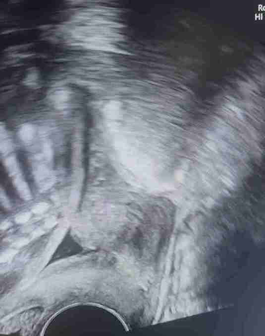 Serklaj (Rahim Ağzı Dikişi)