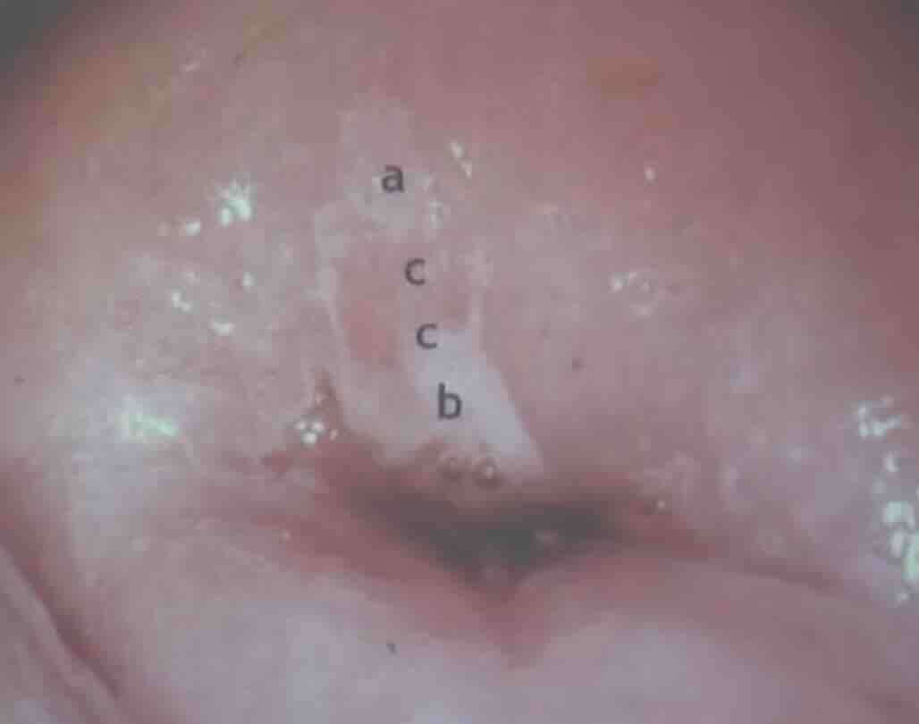 Servikal HSIL ve LSIL Nedir?