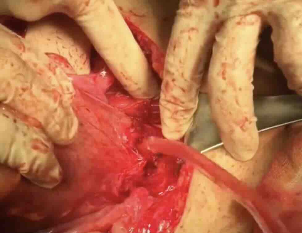 Servikal Serklaj Nedir? Neden ve Nasıl Uygulanır?