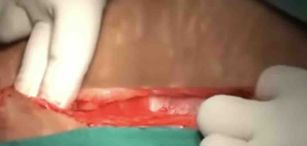 Sezaryen Dikişi Hakkında Her Şey