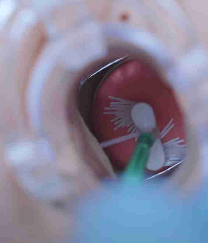 Smear Testi Ankara-Ne Zaman ve Neden Yapılmalı?