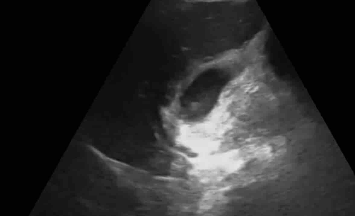 ULTRASONDA BEBEK SAFRA KESESİ OLMAMASI (Fetal Safra Kesesi Agenezisi)