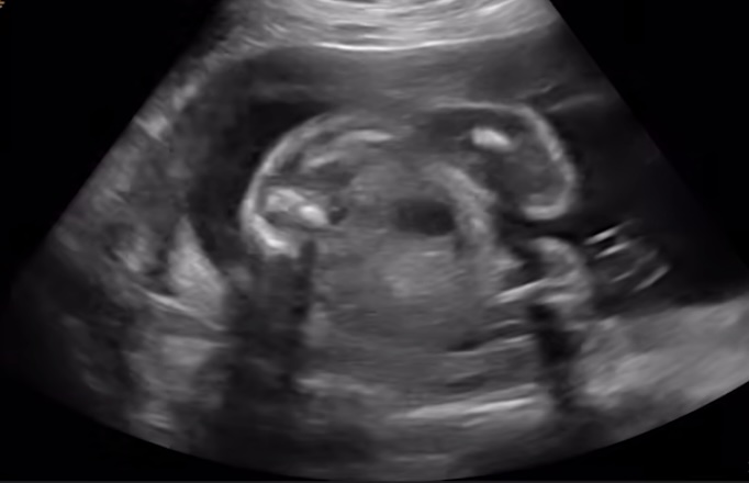 Ultrasonda Cinsiyet Yanılması: Neden Olur, Ne Zaman Kesinleşir?