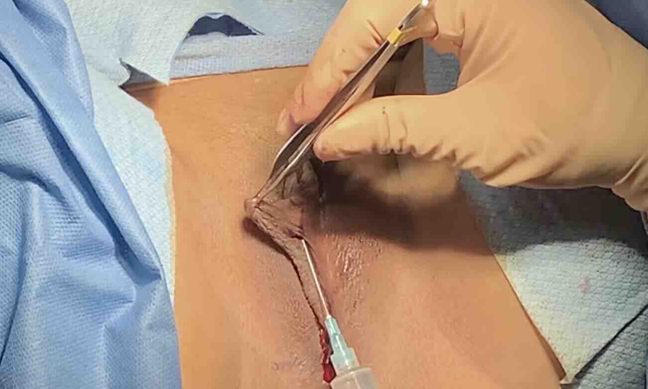 Vajina Estetiği (Barbie)