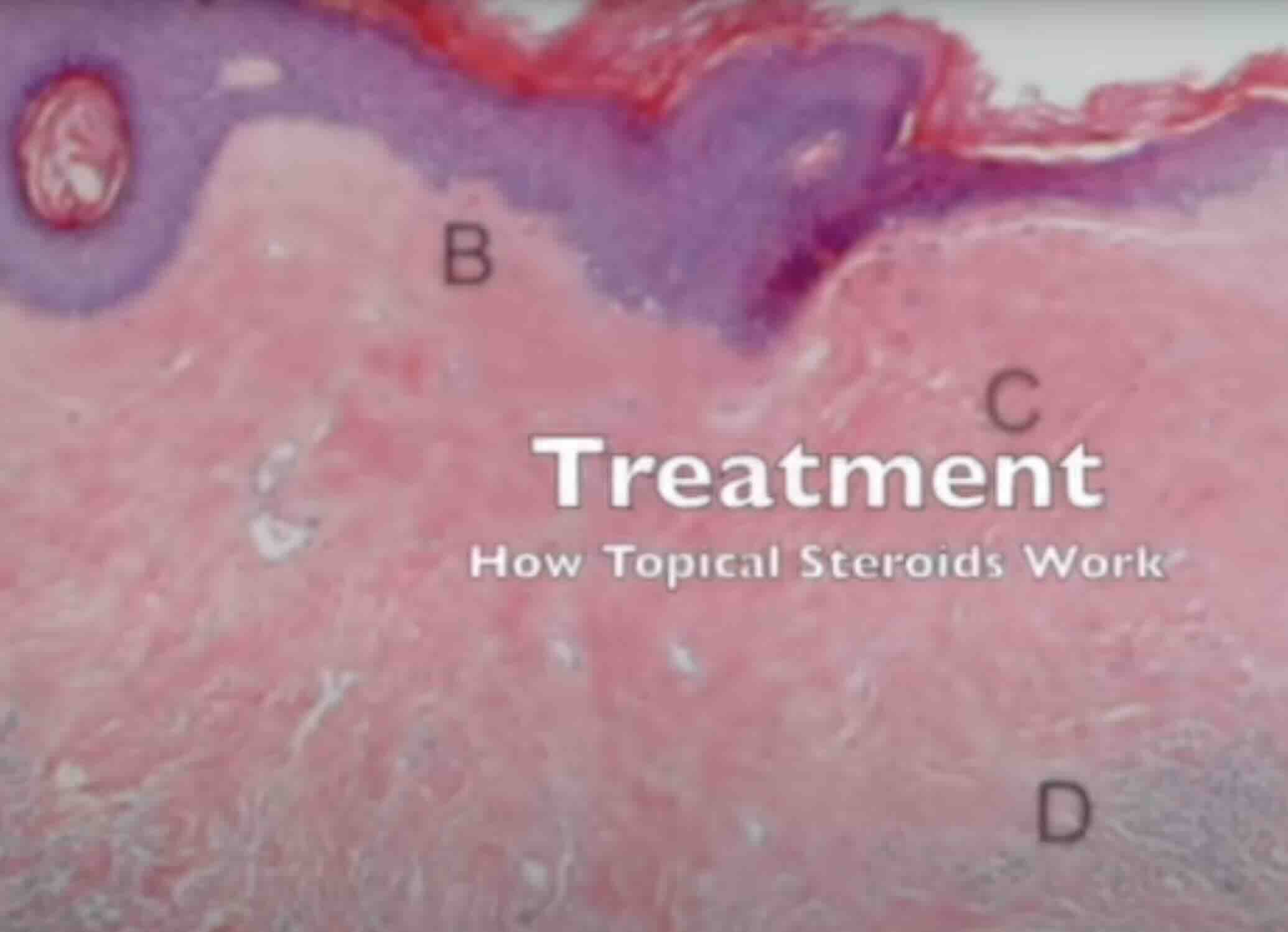 Vulvar Liken Skleroz