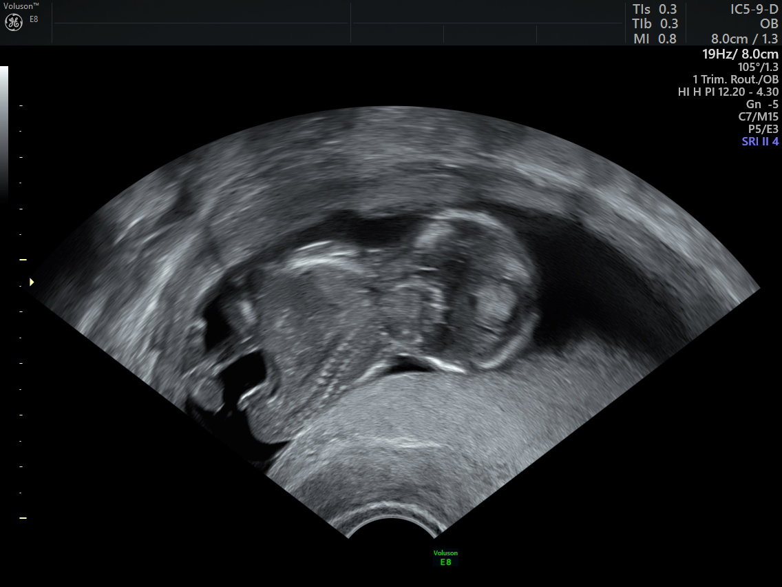 Yapışık İkizlik Nedir? Belirtileri, Nedenleri, Tanı Yöntemleri ve Tedavisi