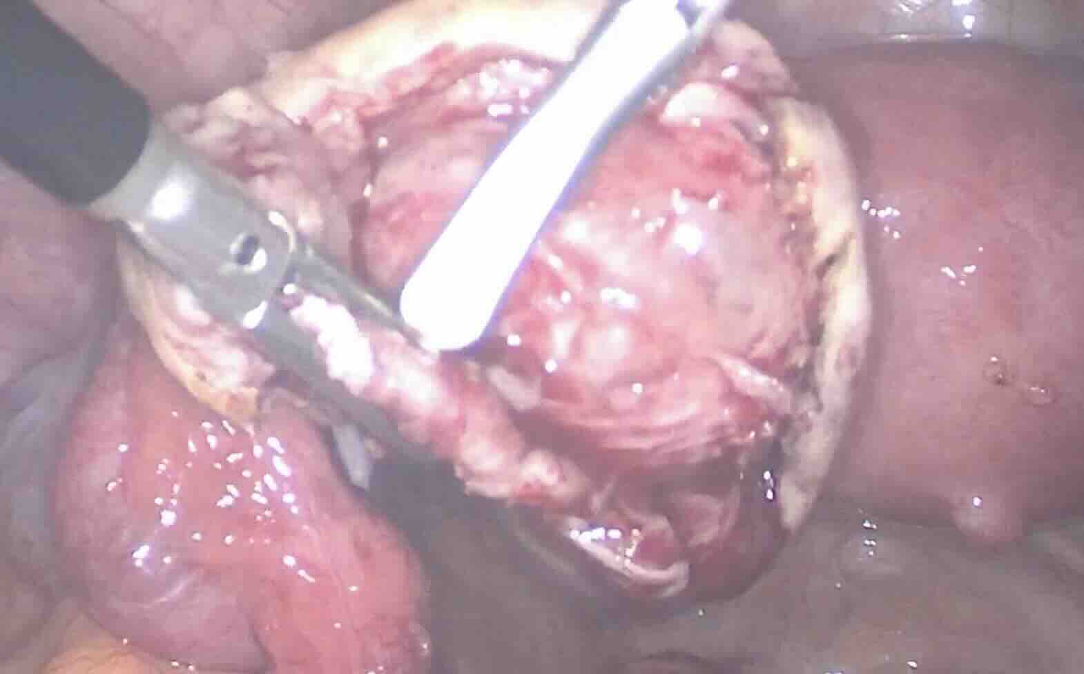 Yumurtalıkta Dermoid Kist Nedir?